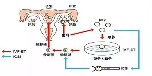 宁波试管婴儿包干价